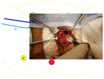 varicose pelvis la femei