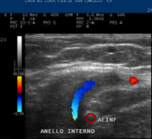bazinul mic varicose pelvic