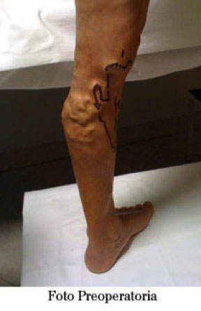 preoperatoria